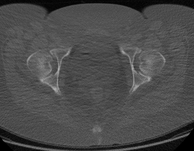 Eine Schwarz-Weiß-MRI-Aufnahme des Unterleibs eines Mannes, die sich auf die Prostata konzentriert und detaillierte anatomische Strukturen zeigt.